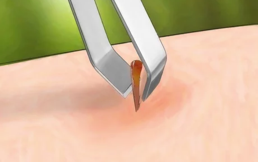 Loai-bo-noc-va-ngoi-doc-con-trung-can